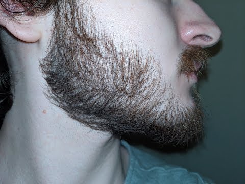 minoxidil-for-beard-growth:-day-280-//-40-week-progress