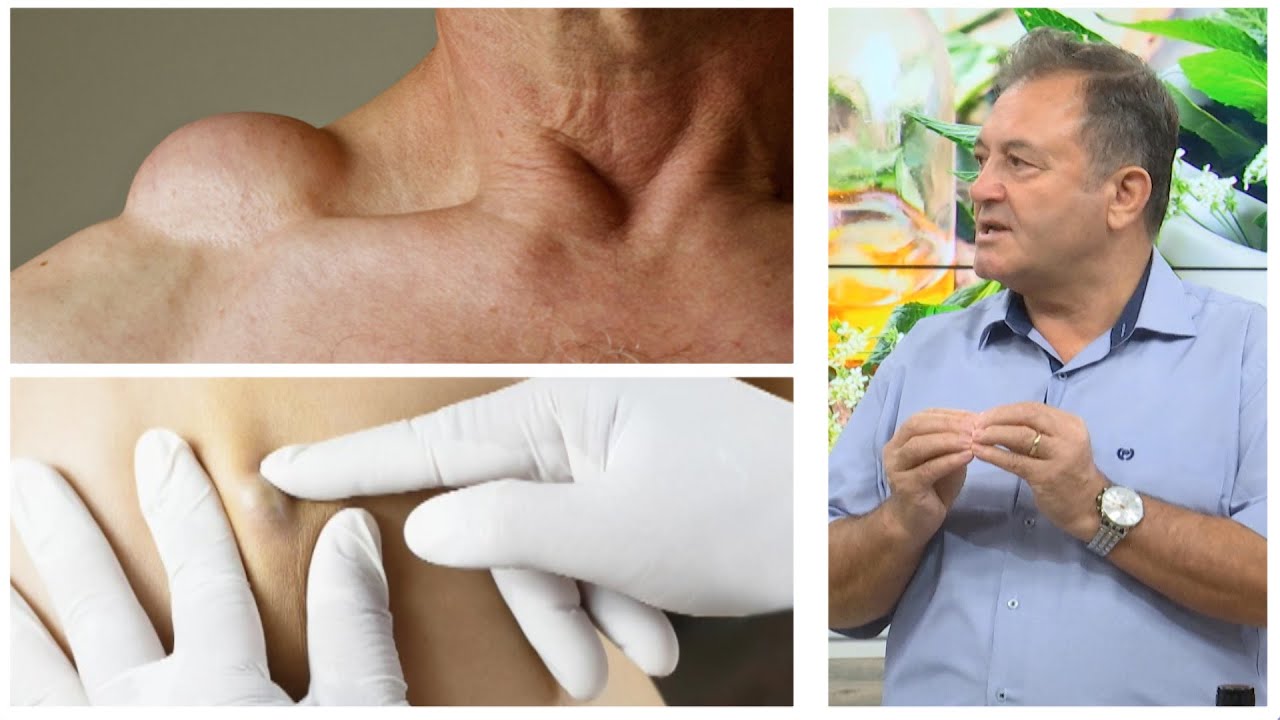 Gjëndër dhjamore apo tumor? Ja si të bëni dallimin / Ylli Merja: Trajtimi natyral i lipomave