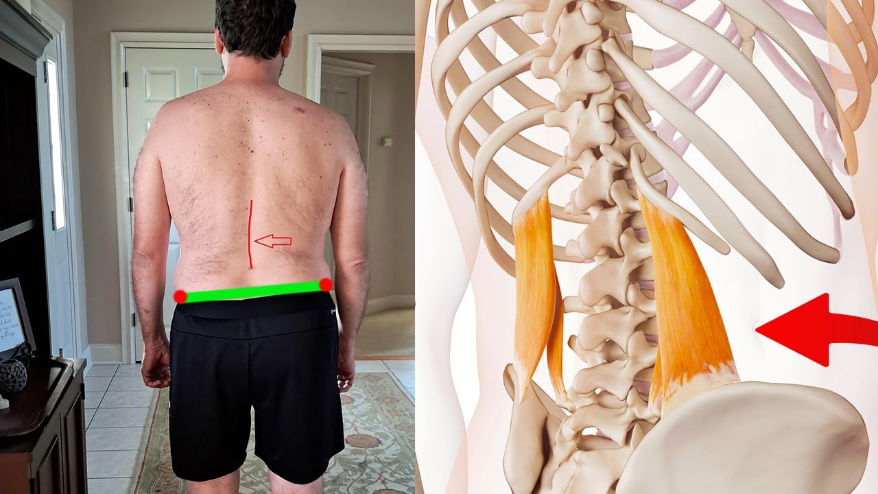 Fix Lateral Pelvic Tilt & One-Sided Lower Back Pain (QL & erector ...