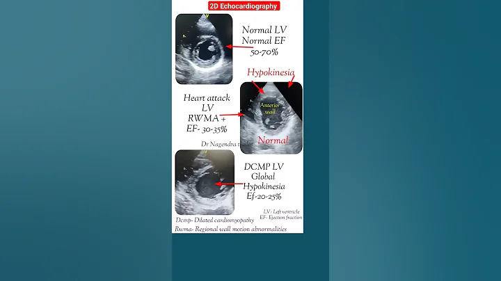 Normal,heart attack, DCMP Echo #echo #shorts