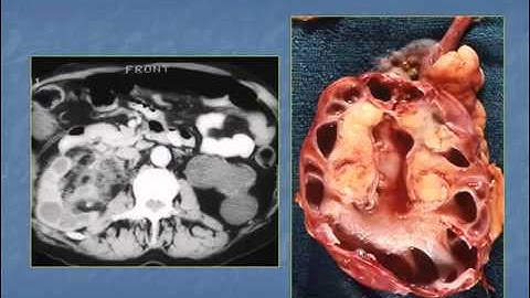 Chẩn đoán hình ảnh  nhiễm khuẩn tiết niệu CDHA   YouTube