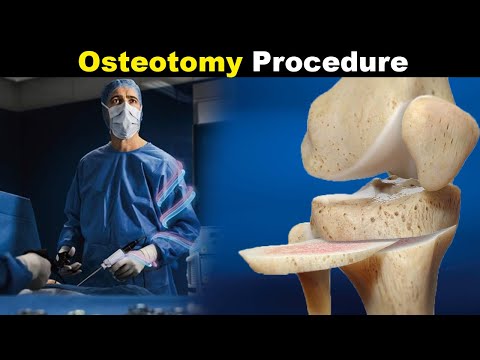 How Osteotomy Procedure Is Performed? | Osteotomy Types (Urdu/Hindi)