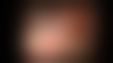 Management of peptic ulcer bleeding in gastric antrum using Ovesco OTSC System