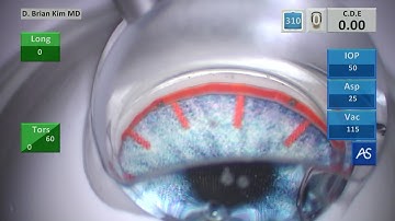 SimulEYE Model iStent inject W Training & Certification: First Experience
