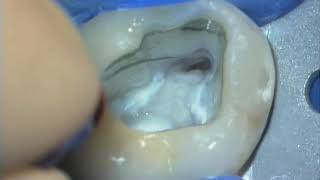 Access Refinement - Removing Triangles of Dentin: Advanced Endodontics: Dr. Ruddle