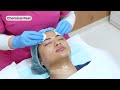 Chemical skin peel is a cosmetic procedure designed to improve the skins texture and color tone