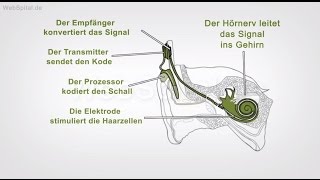 Cochleaimplantat