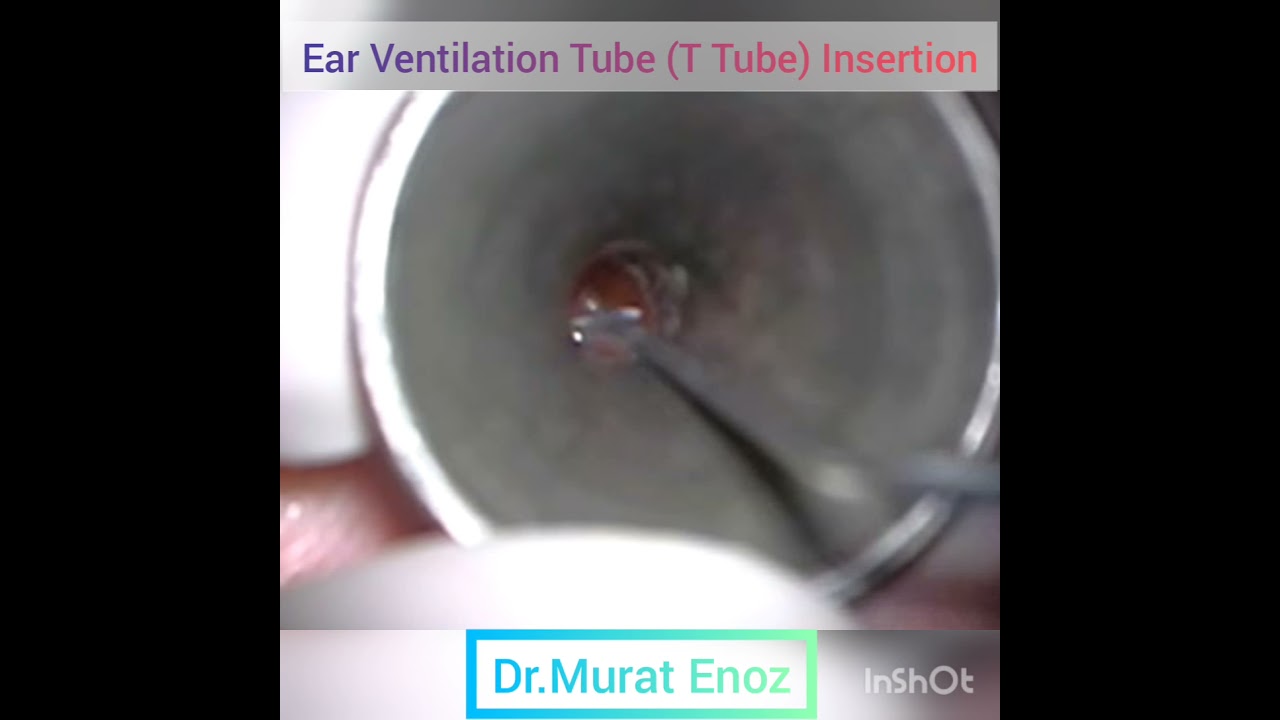 Ear Ventilation Tube T Tube Placement YouTube ear-ventilation-tube-t-tube-placement-youtube