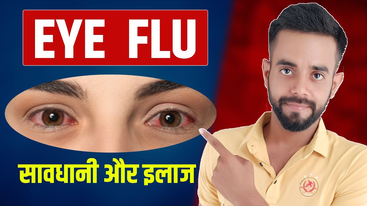 Eye Flu Treatment Eye Flu Home Remedies Eye Flu Cause, Prevention & Treatment आई फ्लू का
