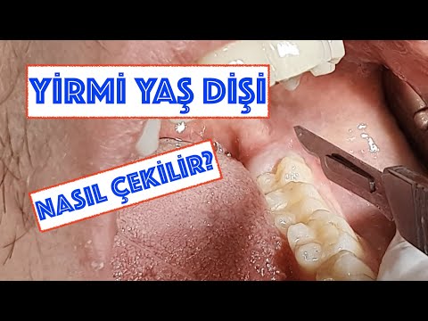 Video: Emme diş çektirmeleri nasıl çalışır?