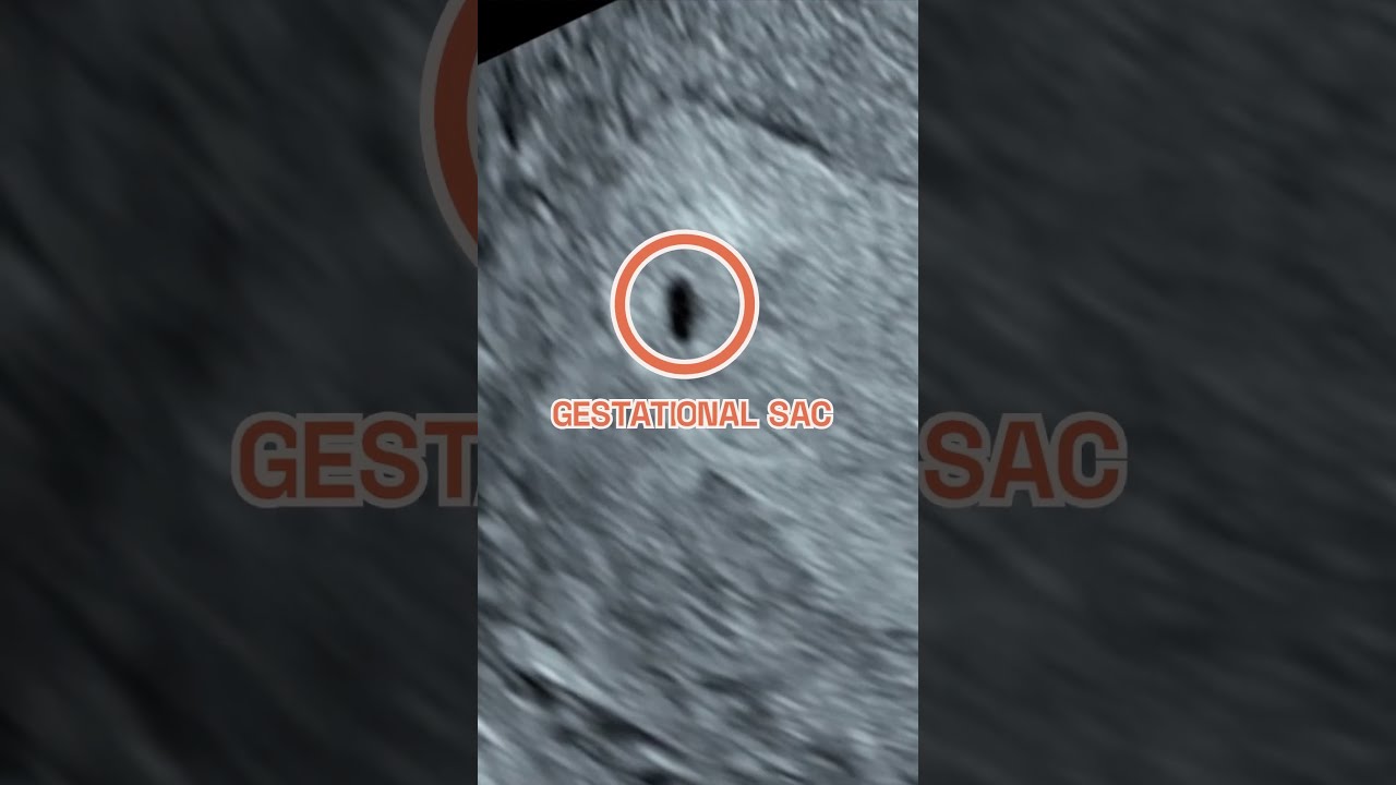 Your Baby At 4 Weeks Pregnant Early Ultrasound Scan