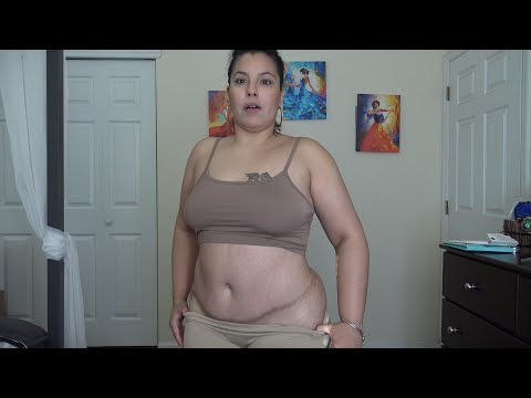 TWO YEARS AFTER MY TUMMY TUCK SURGERY