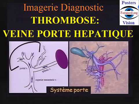 Thrombose de la veine porte hepatique: diagnostic imagerie