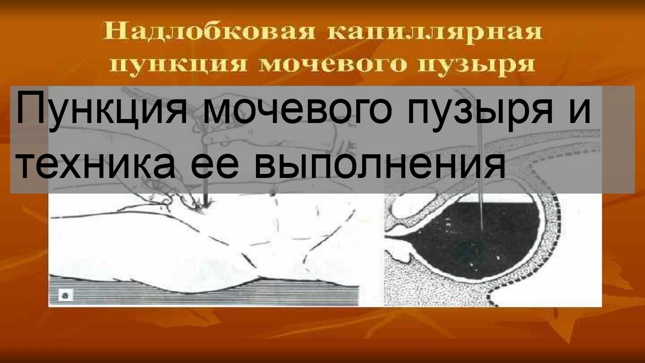Пункция мочевого пузыря и техника ее выполнения