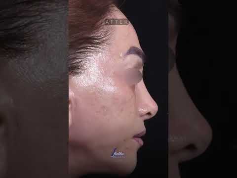 نتیجه ی فوق العاده لیفت کامل صورت جراحی بینی بلفاروپلاستی و لیفت سانترال لب بعد از ۱ سال