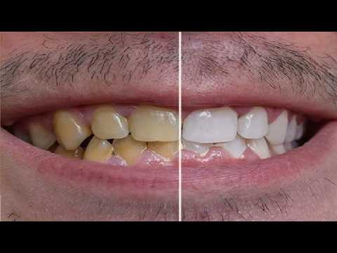 HOW TO GET RID OF YELLOW TEETH PROVEN METHODS