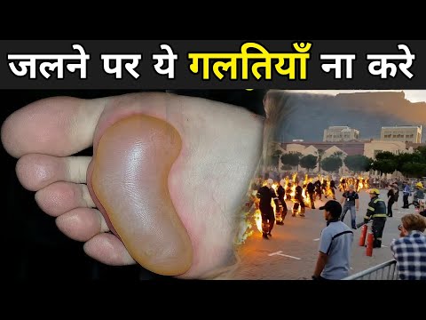 जलने पर ये गलतियाँ ना करे | Common Mistakes On Burning