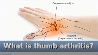CMC/Thumb Arthritis : Learn More from a Hand Therapist