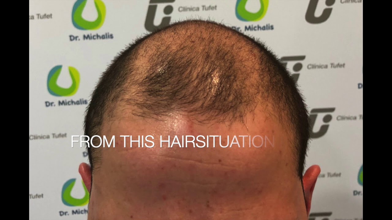 3400 Grafts Fue Hair Transplant On A Bald Head Nw 6 Situation Fue Haartransplantation Youtube