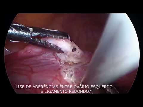 Ooforoplastia  Dr. Luiz Flávio