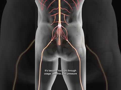 Is The Piriformis Entrapping Your Sciatic Nerve?