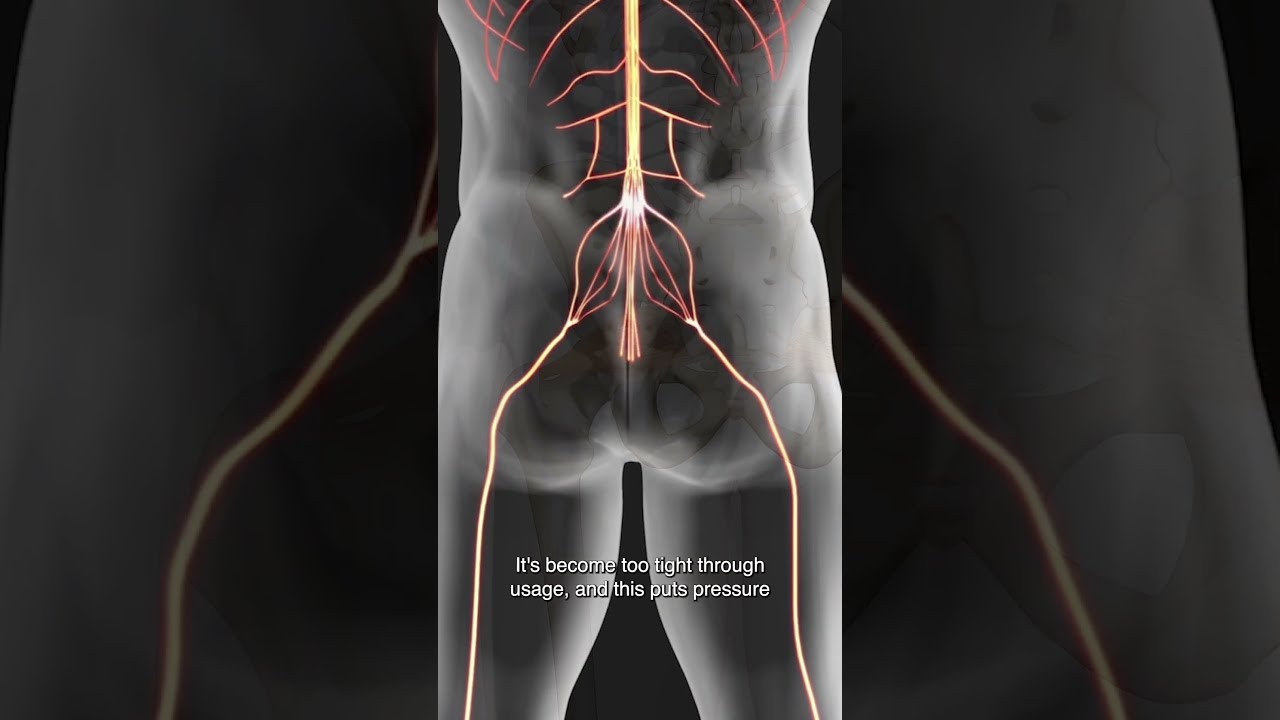 Is The Piriformis Entrapping Your Sciatic Nerve 
