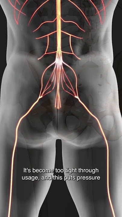 Is The Piriformis Entrapping Your Sciatic Nerve?