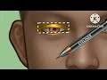 ASMR satisfying man face waxing &amp; Acne  removal skin care Animation Big ASMR|