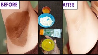 काले Underarms को गोरा करने का असरदार तरीका || How To Get Rid Of Dark Underarms