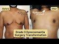 Grade 3 gynecomastia  incredible results after cosmetic surgery in pune