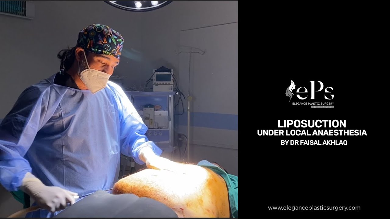 Liposuction Surgery Under Local Anaesthesia!! YouTube