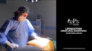 Liposuction Surgery Under Local Anaesthesia!!