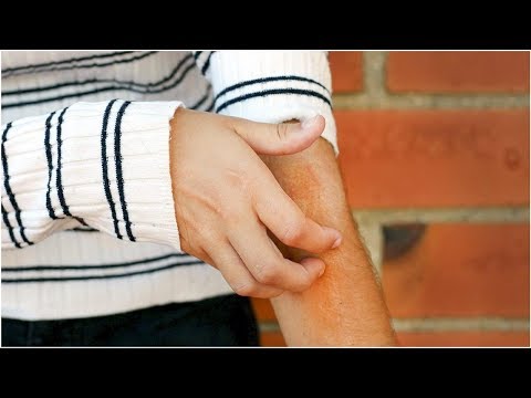 Symptoms and Stages of a Brown Recluse Spider Bite | Tita TV