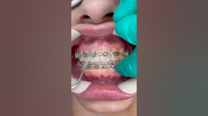 Orthodontie #shorts