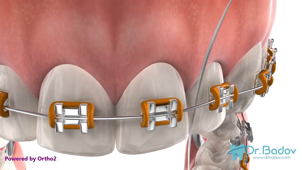 #миененазъбисбрекети #брекети Как да си мием зъбите ако носим брекети?