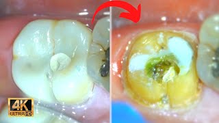 Tooth Decay under a Crown { Cavity Removal Process w/ Microscope } by Smile Influencers 32,131 views 1 year ago 5 minutes, 32 seconds