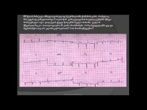 ეკგ / მარცხენა პარკუჭის ანევრიზმა / გულის ანევრიზმა / marcxena parkuchis anevrizma / gulis anevrizma