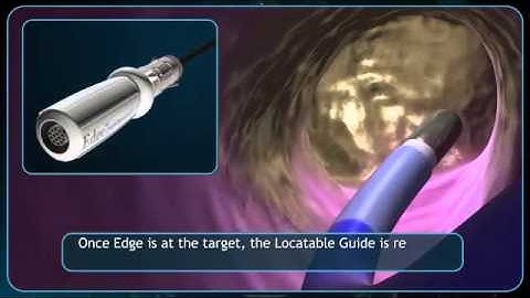 electromagnetic navigation bronchoscopy (ENB).