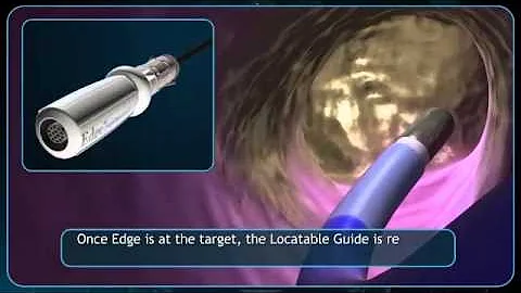 electromagnetic navigation bronchoscopy (ENB).