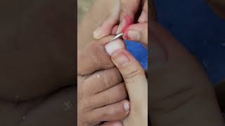 Remove ingrown toenail part 10