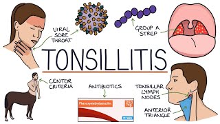 Tonsillitis Drk