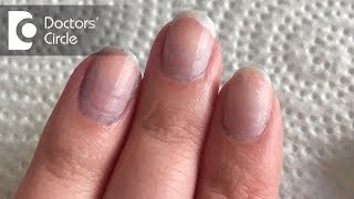 What Causes Bluish Discoloration Of Nail Beds? - Dr. Rashmi Ravindra