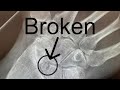 I broke my wrist making a YouTube video now my plumbing and gas career on the tools could be over.