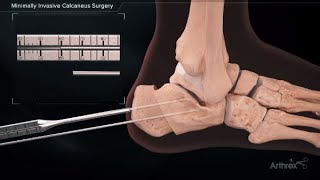 Minimally Invasive Calcaneus Surgery screenshot 3