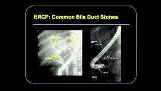 Difficult Problems in Reasonable Patients Panel: Recurrent RuQ Pain and Abnormal lFTs