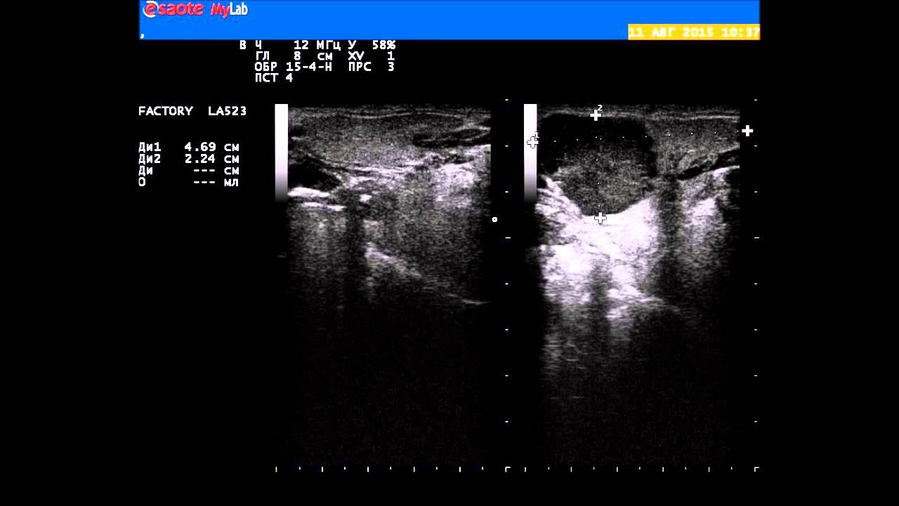 Опухоль (Рак?) слюнной железы. УЗИ
