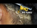 Scratching Huge Dandruff Flakes Never End!! Dandruff Removal Satisfying #354