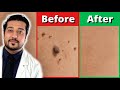 How to rid skin tags faster  3 easy skin tag removal steps