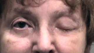 Unilateral Ophthalmoplegia