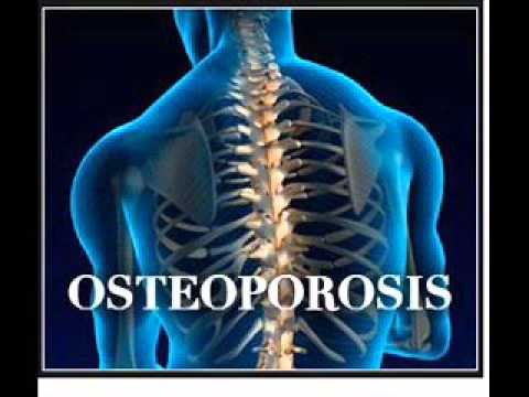 osteoporozė